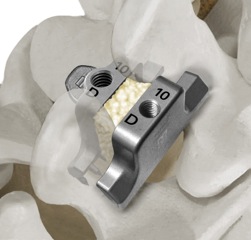 interlaminar spinal fixation system