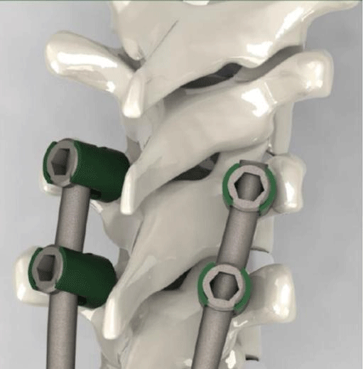 Mechanical Stability Insert