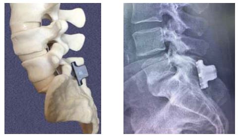 An image of a spinal cord with a stabilink implant and the x-ray to the right of it showing the implant as well.
